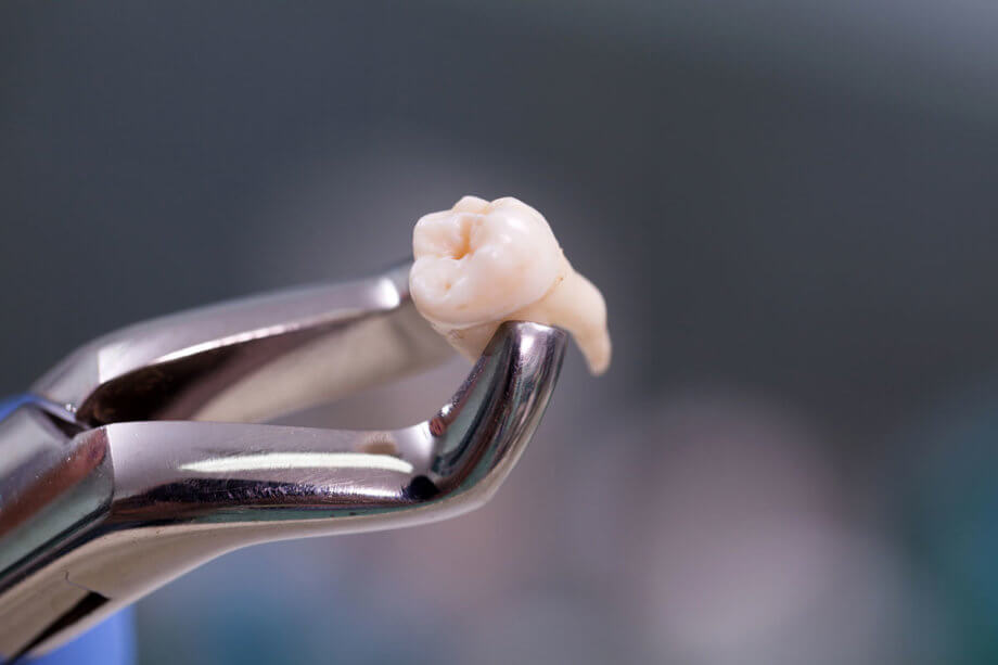 The Single Strategy To Use For After Wisdom Teeth Removal Care